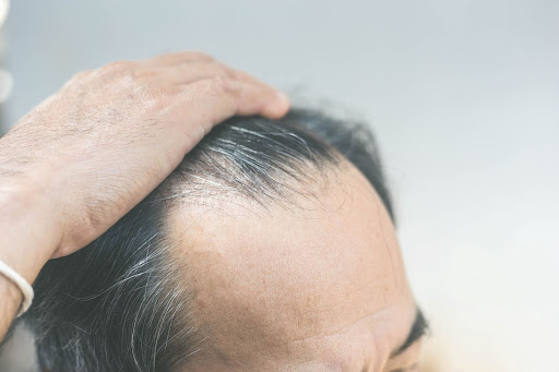 Điều trị rụng tóc ở nam giới bằng phương pháp nào